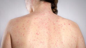 Ante un posible caso de sarampión en Buenos Aires el Ministerio de Salud de la Nación emitió un alerta epidemiológico